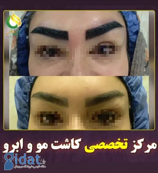 نمونه های کاشت ابرو در کلینیک اورانوس